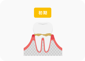 歯肉炎（初期段階）