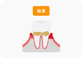 軽度歯周炎