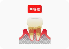 中等度歯周炎