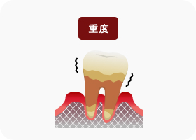 重度歯周炎