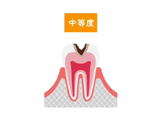 中等度虫歯